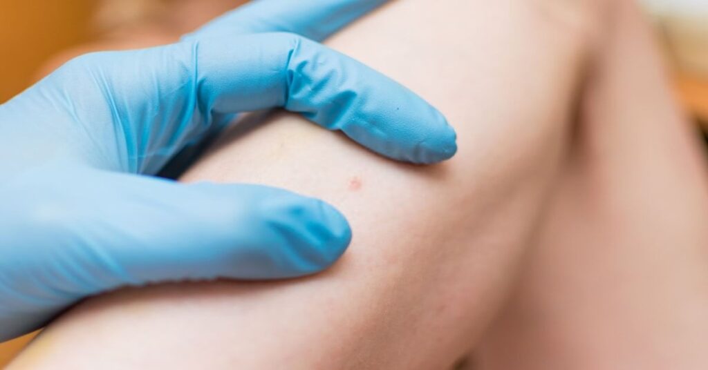 CPT Code for Skin Lesion