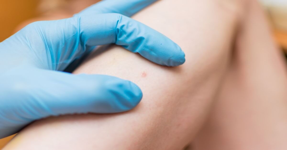 CPT Code for Skin Lesion