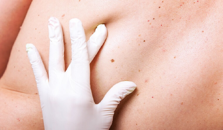 Skin Lesion Biopsy