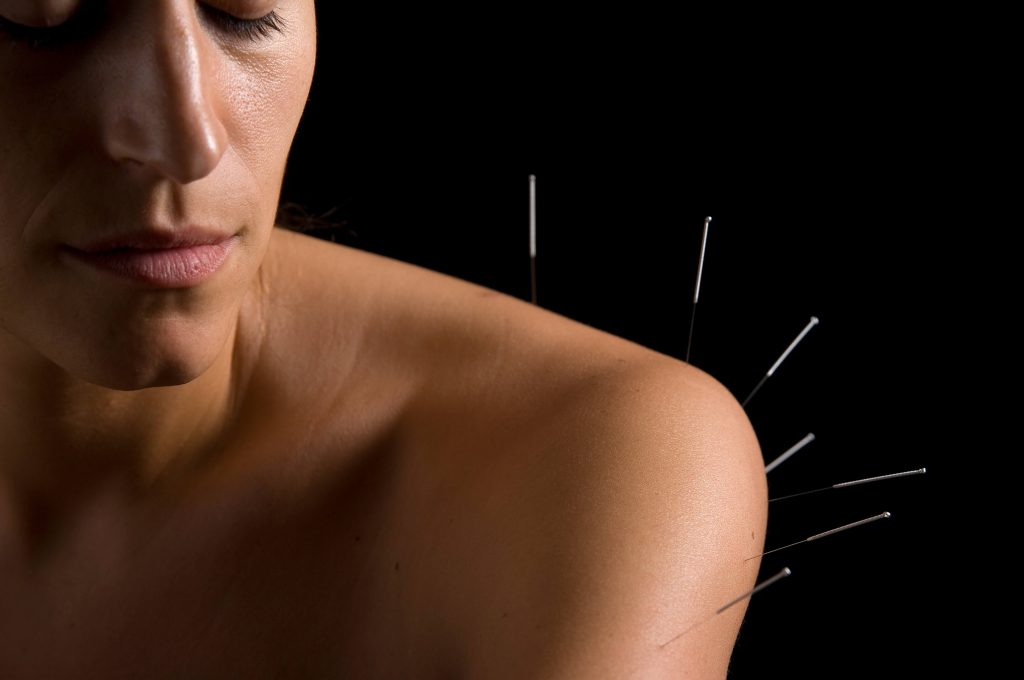 The Landscape of Insurance Coverage for Dry Needling